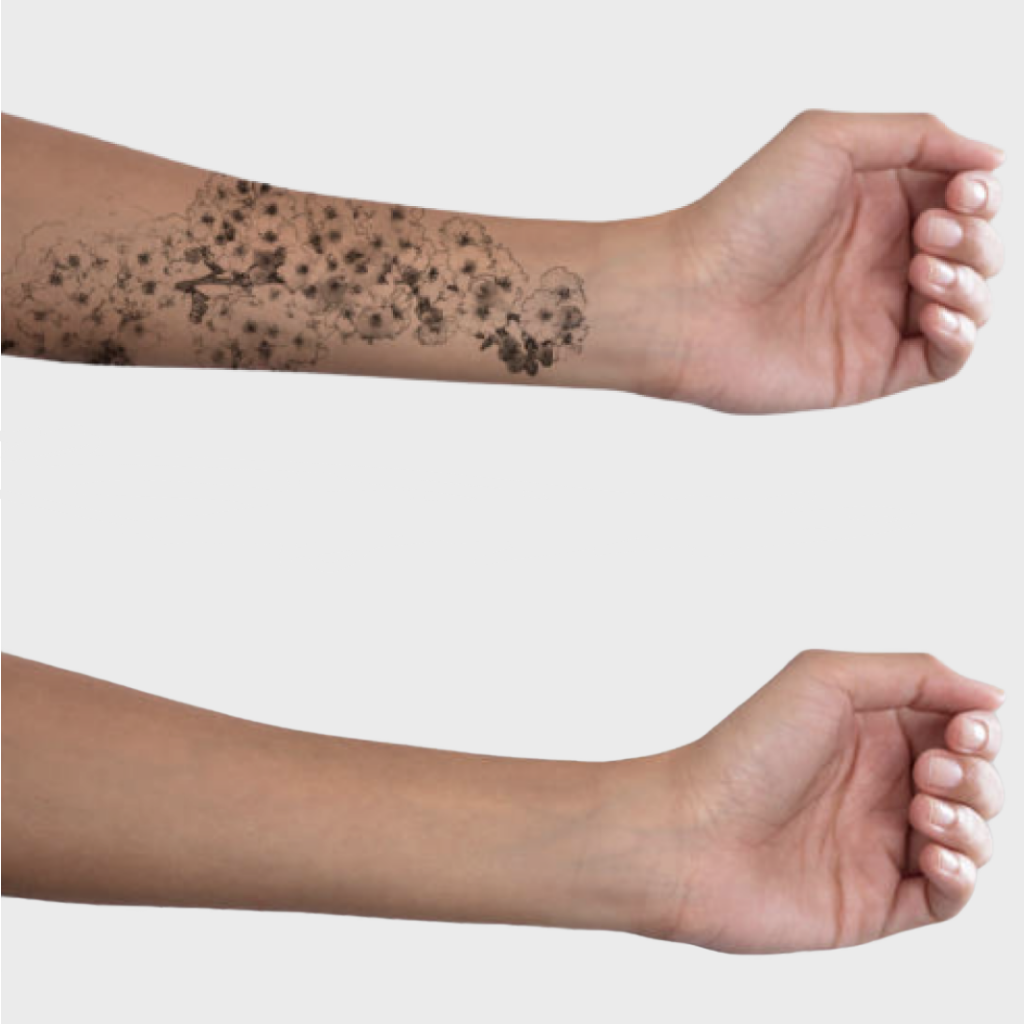 dermabrazyon-ile-dovme-sildirme